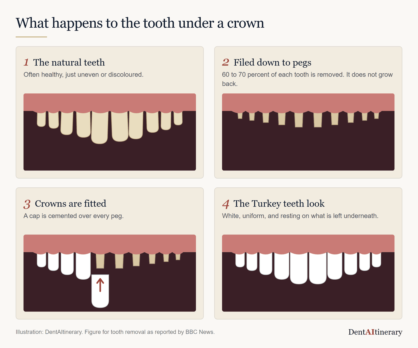 What happens to the tooth under a crown: natural teeth, teeth filed down to pegs, crowns fitted, and the finished Turkey teeth look